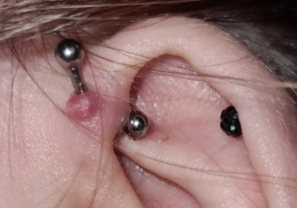 Guzek po piercingu - Rozpoznaj i skutecznie wylecz