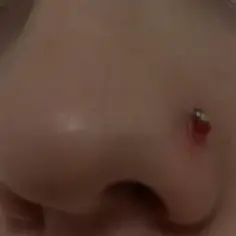 Widoczna ziarnina nostril, czerwona i lekko krwawiąca, przy kolczyku w nosie.