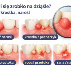 Guzek na dziąśle, krostka, przetoka z ropą lub rana – to objawy problemów z zębami, które mogą wymagać leczenia. Czasem pojawia się ziarnina helix.