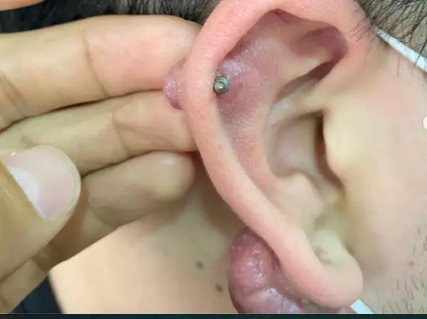 Zgrubienie po przekłuciu - Keloid czy infekcja? Co robić?