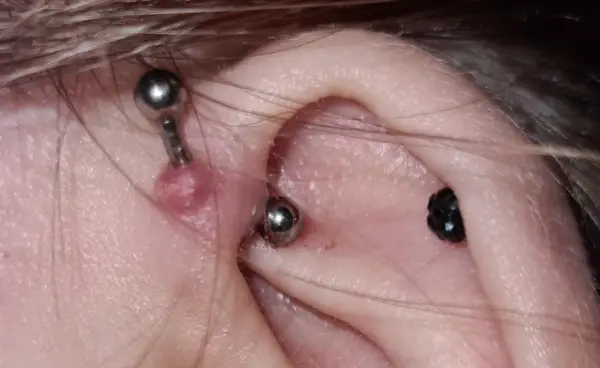 Guzek po piercingu - Rozpoznaj i skutecznie wylecz
