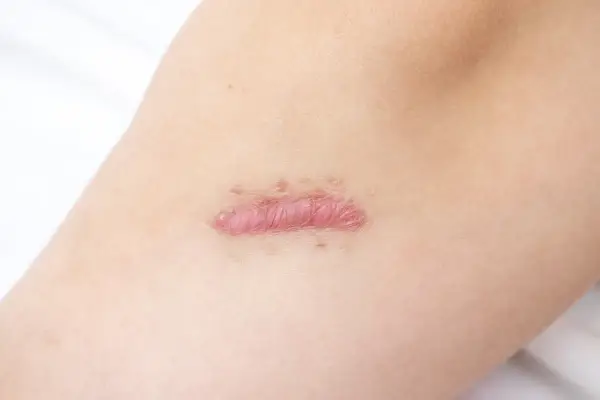 Bliznowiec po piercingu - Jak rozpoznać i leczyć?